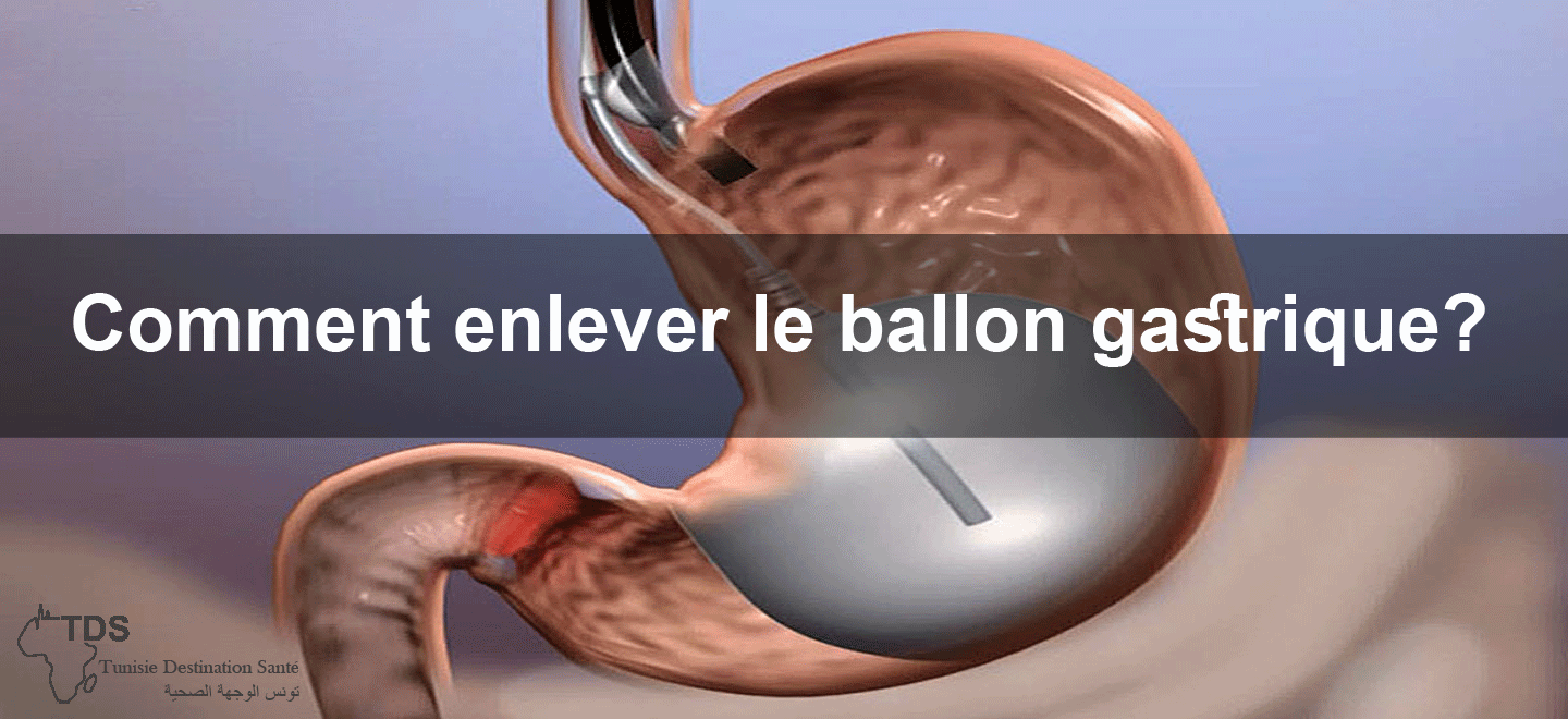 comment enlever le ballon gastrique ?