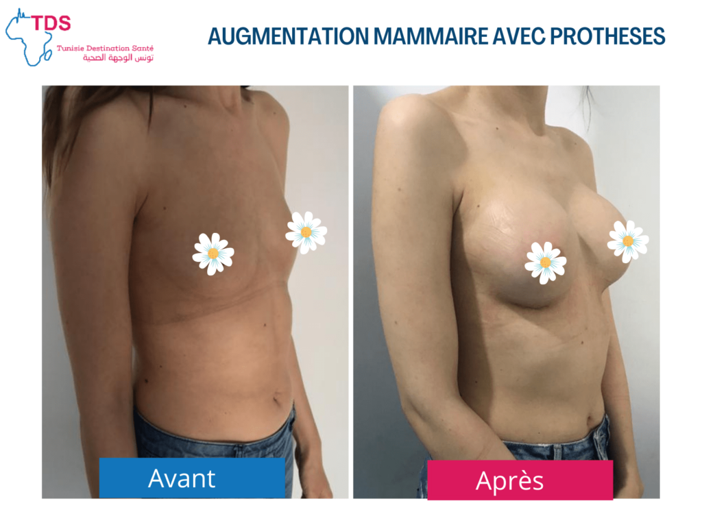 augmentation-mammaire-avec- protheses-avant-apres