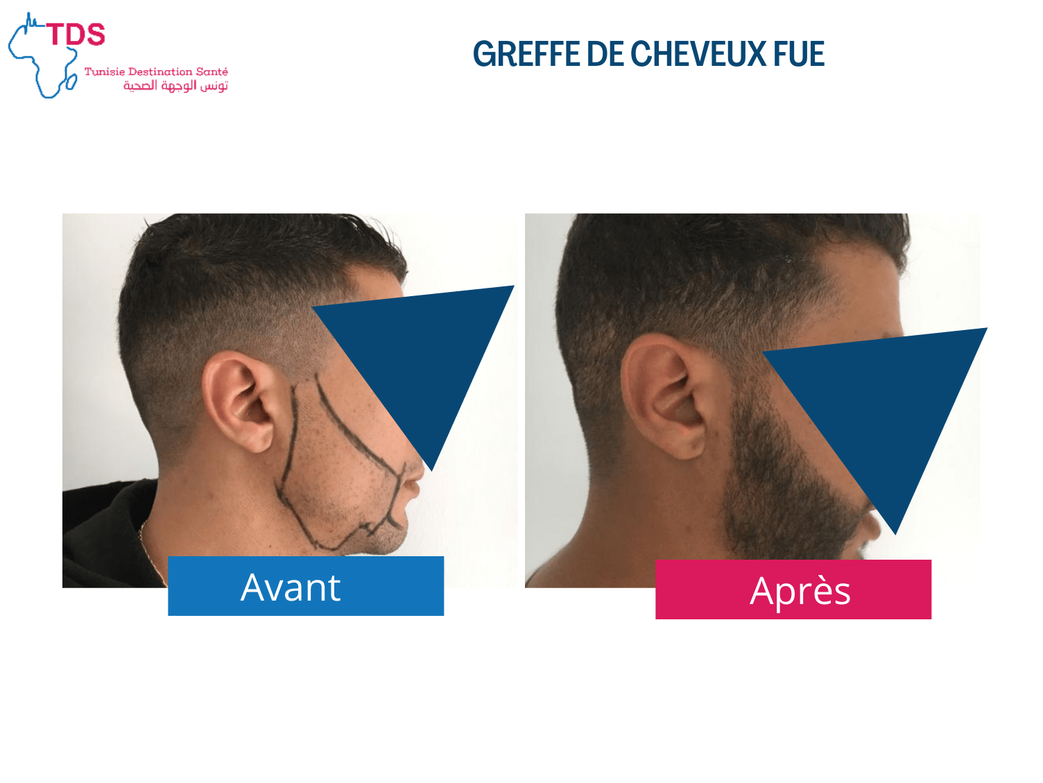 Greffe barbe avant apres