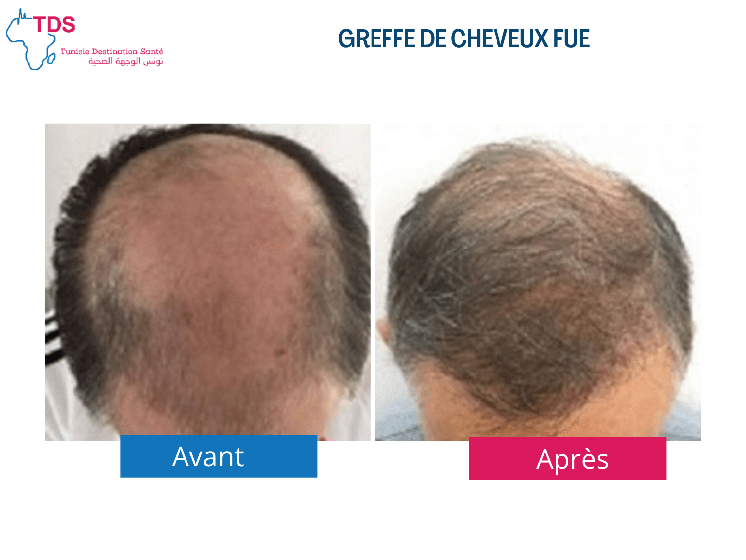 Greffe de cheveux avant apres