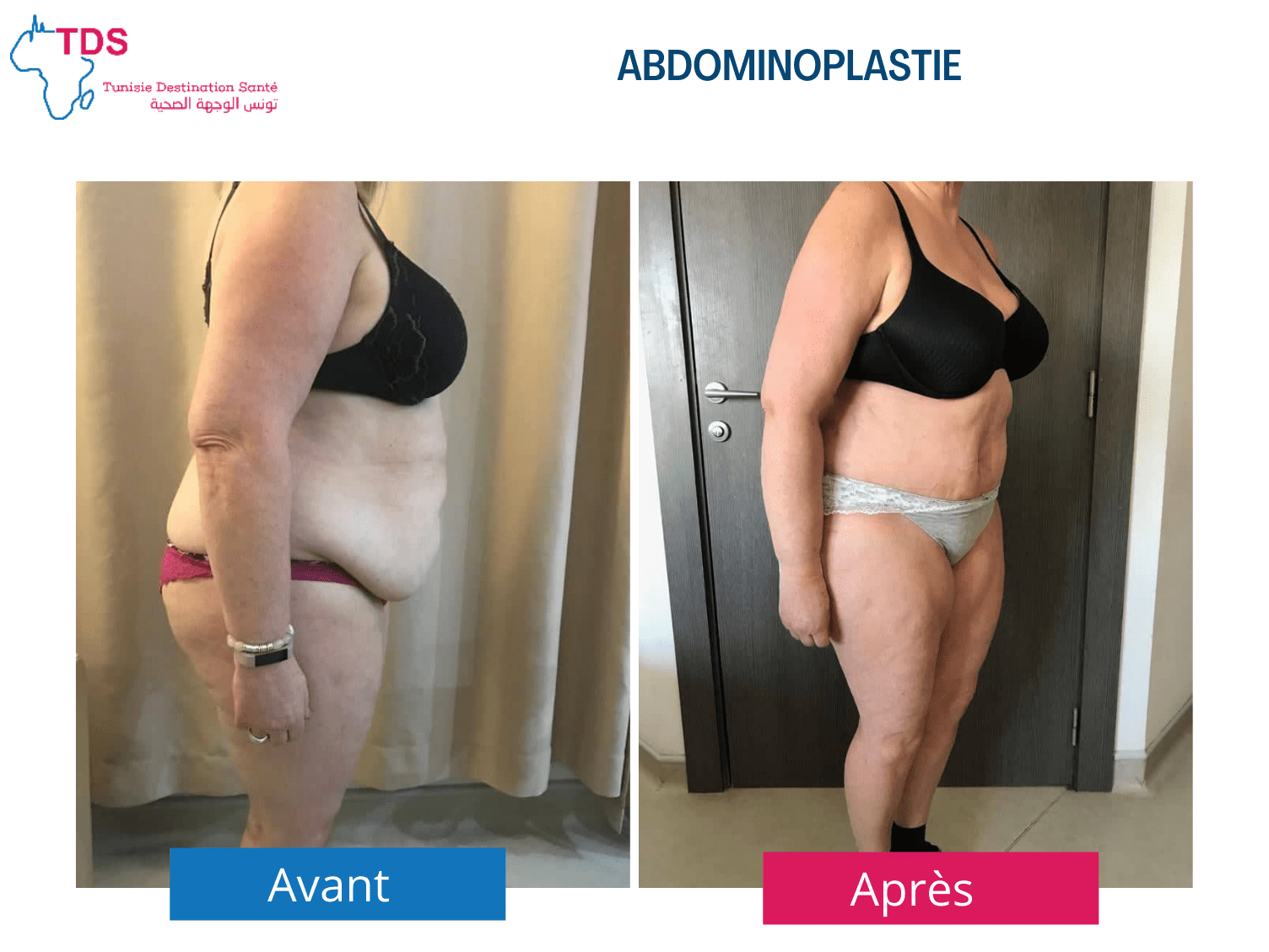 abdominoplastie-avant-apres