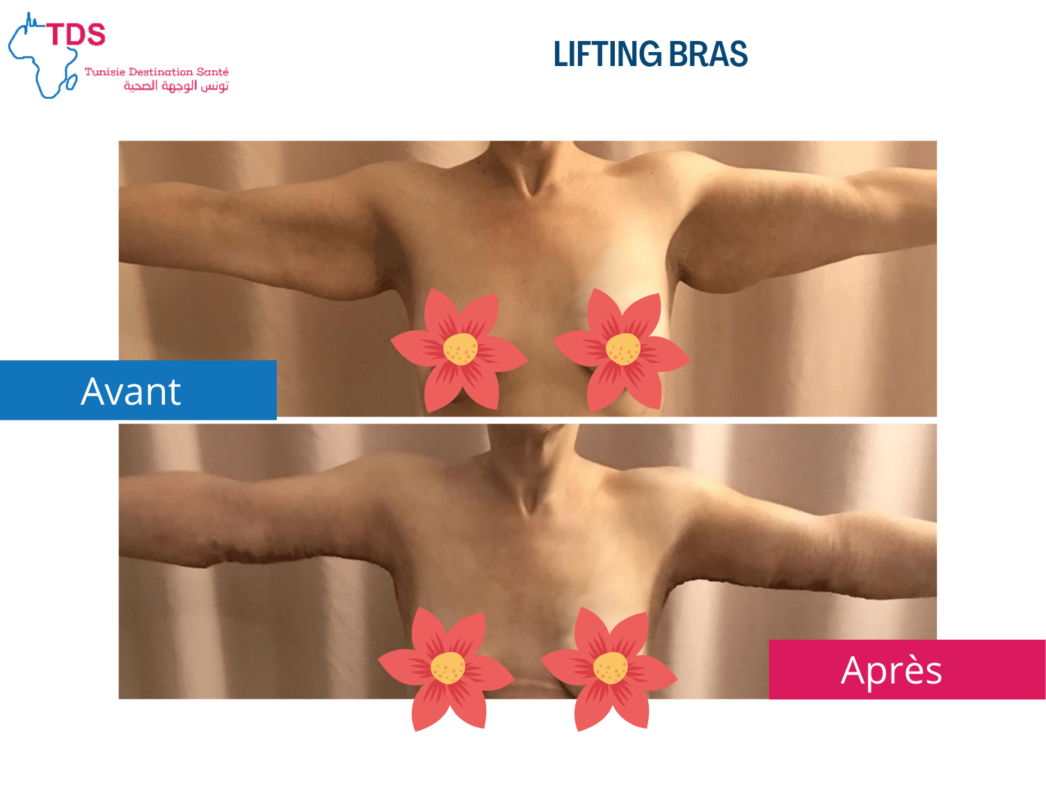 lifting bras avant apres