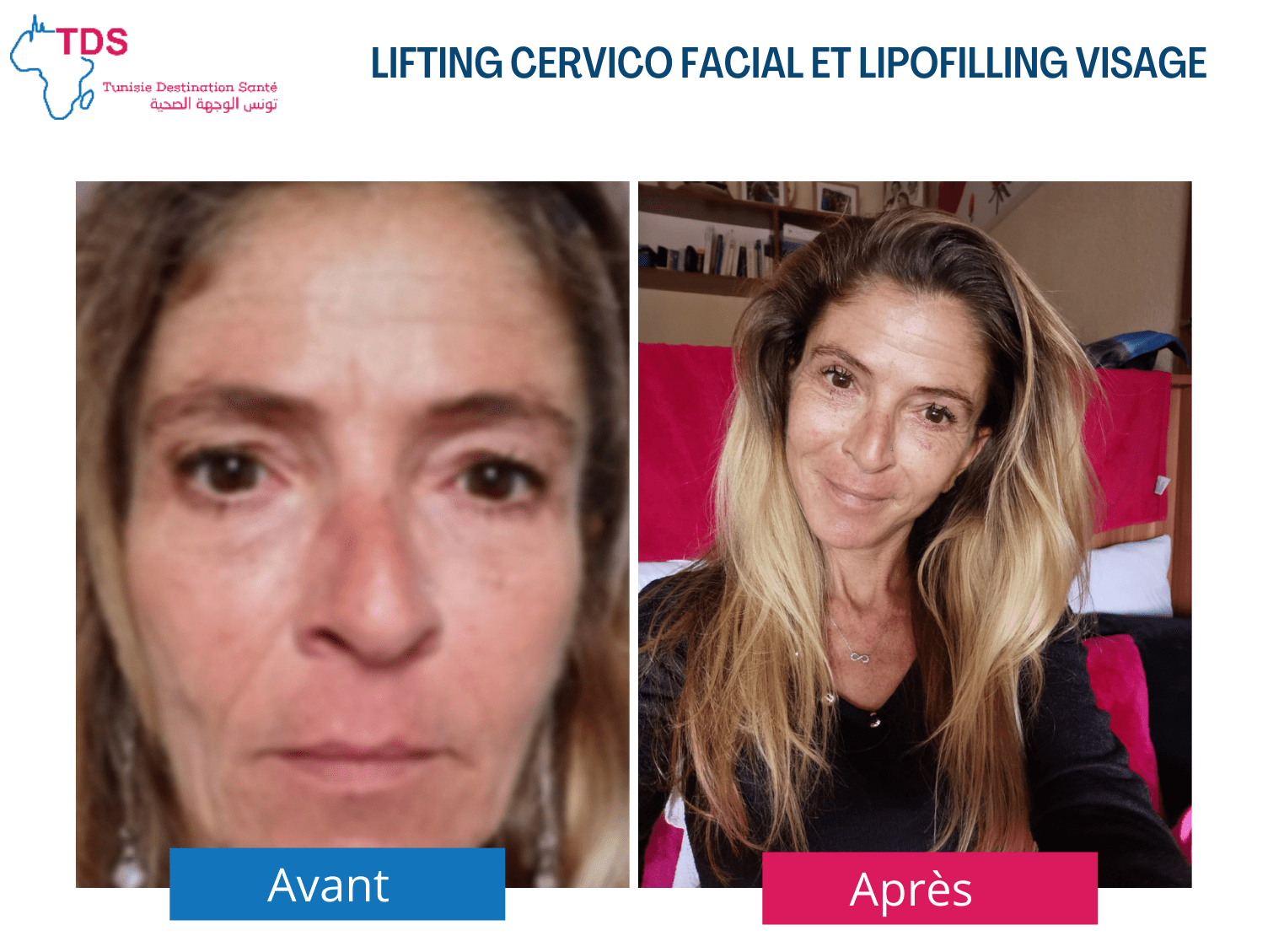 lifting visage avant apres