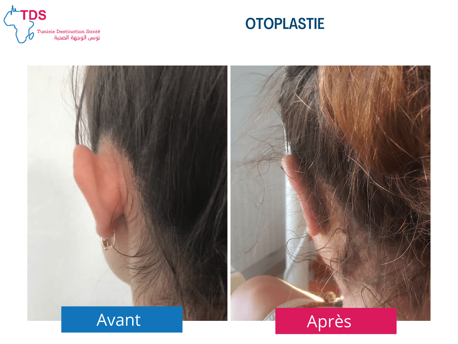 otoplastie avant apres