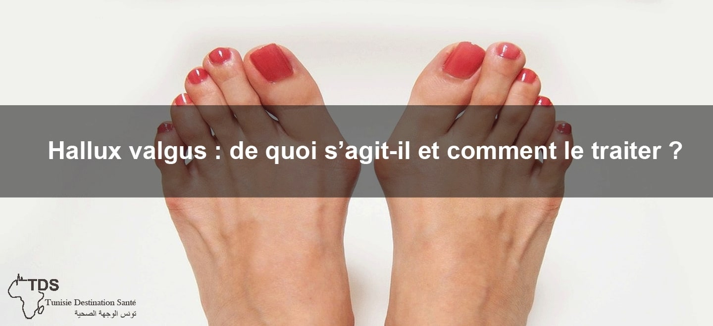 hallux valgus