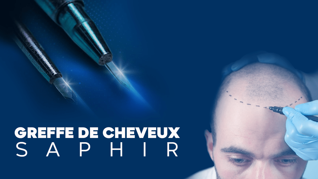 implant capillaire saphir