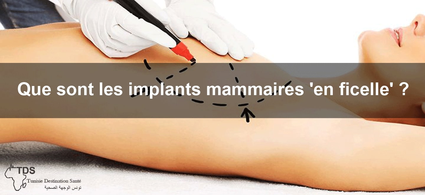 implant mammaire en ficelle