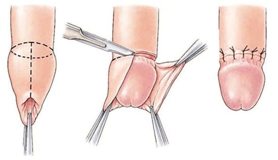 circoncision Tunisie