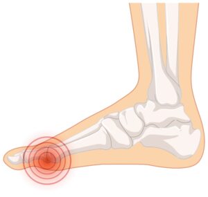 Hallux valux