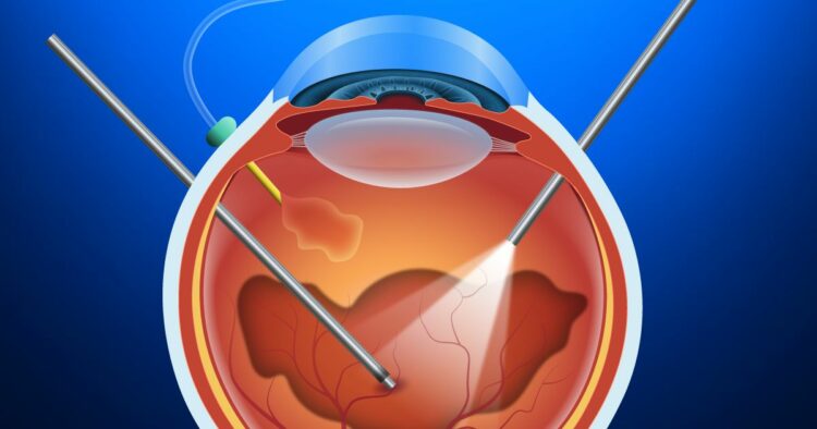 vitrectomie chirurgie oculaire