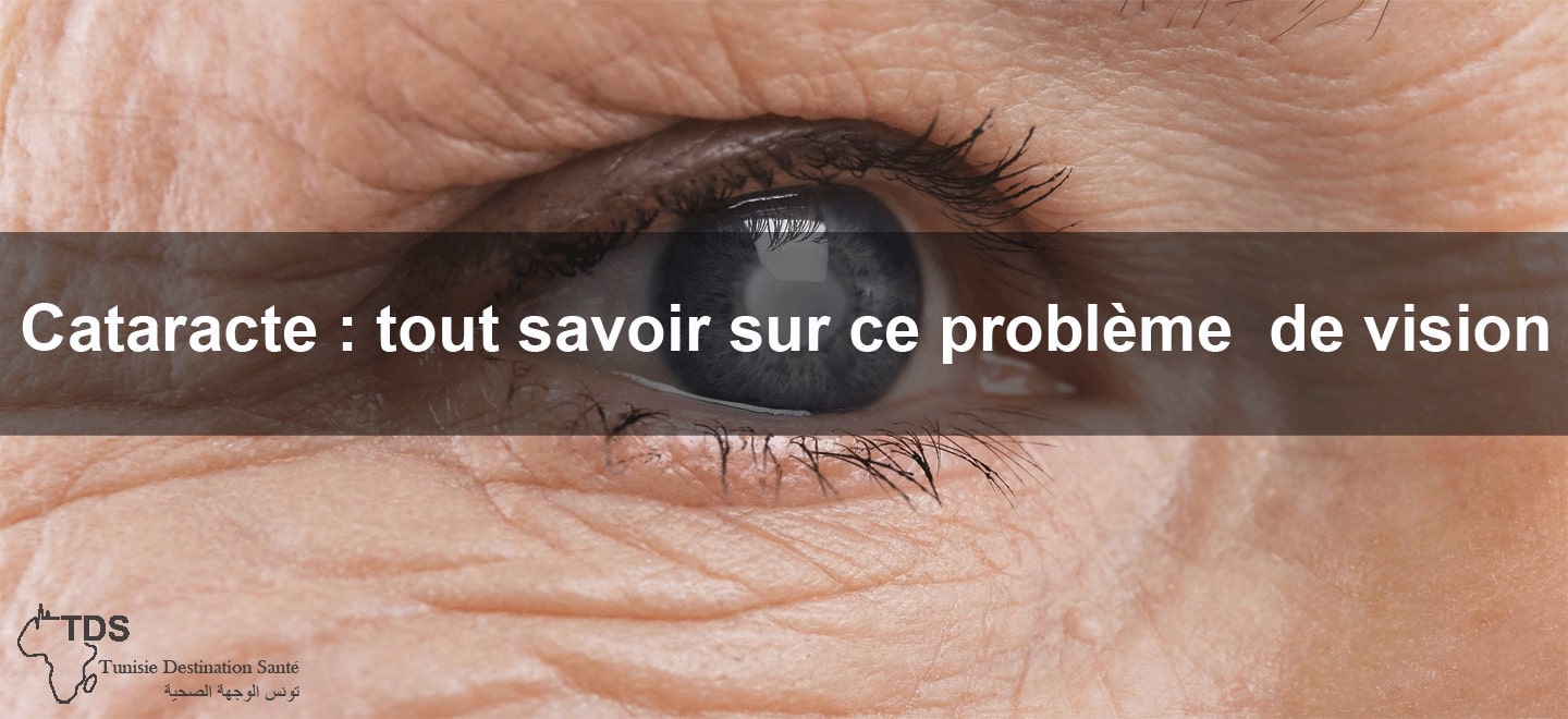 cataracte tout savoir