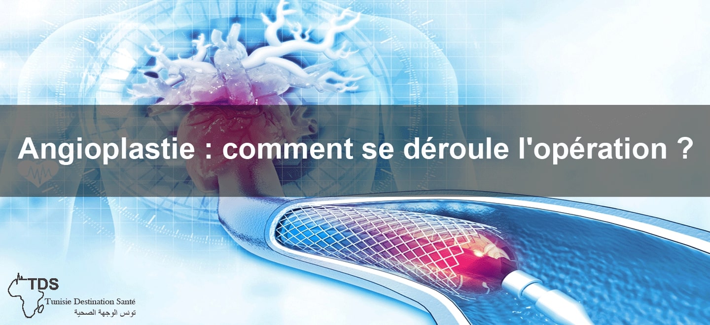 angioplastie comment se déroule l’opération