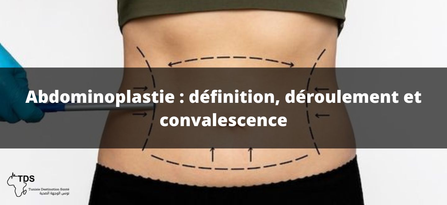 Abdominoplastie définition, déroulement et convalescence