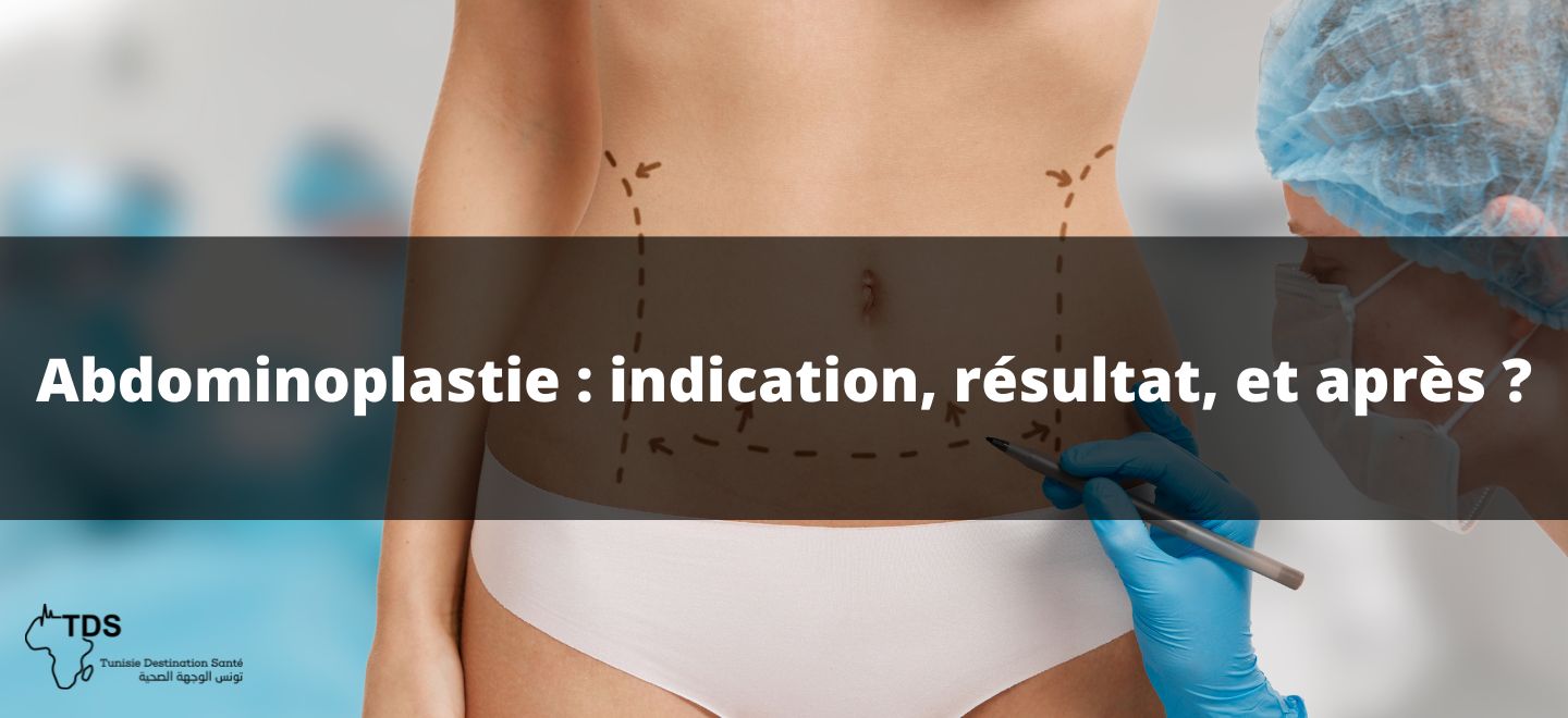 Abdominoplastie indication, résultat, et après