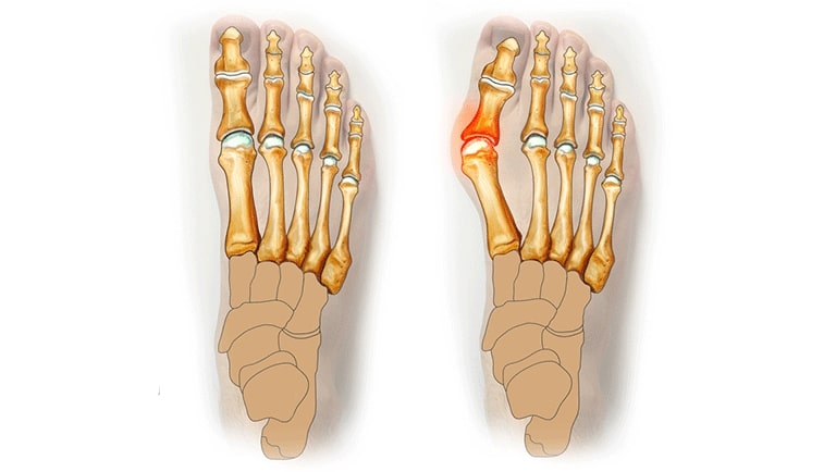 Hallux valgus deviation de lorteil