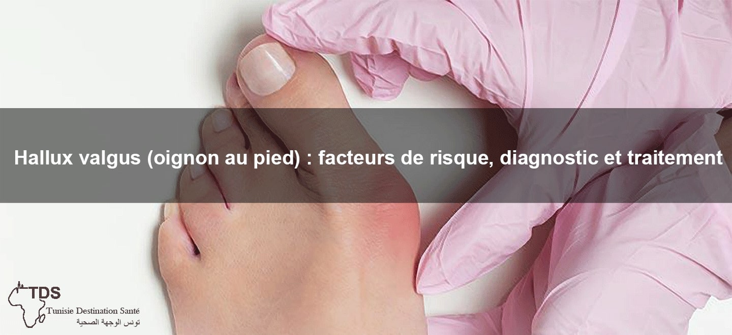 Hallux valgus (oignon au pied) facteurs de risque , diagnostic et traitement