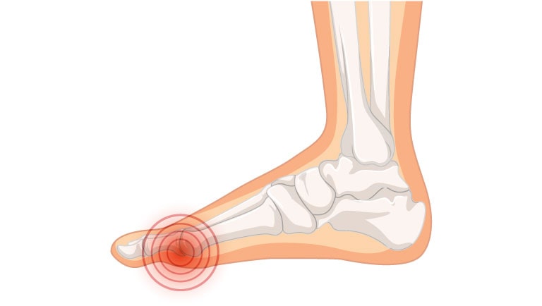 Hallux valgus (oignon au pied)