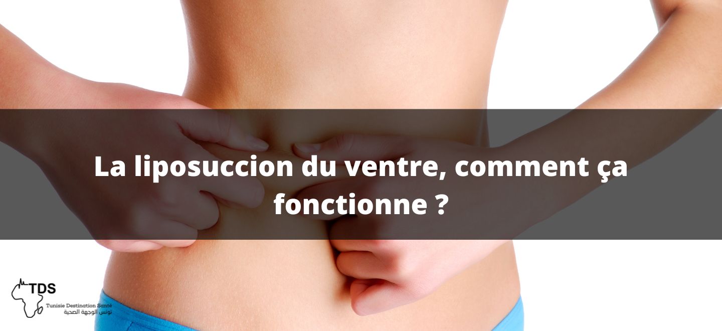 La liposuccion du ventre, comment ça fonctionne