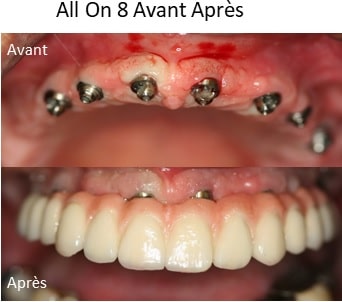 implant dentaire all on 8 avant après