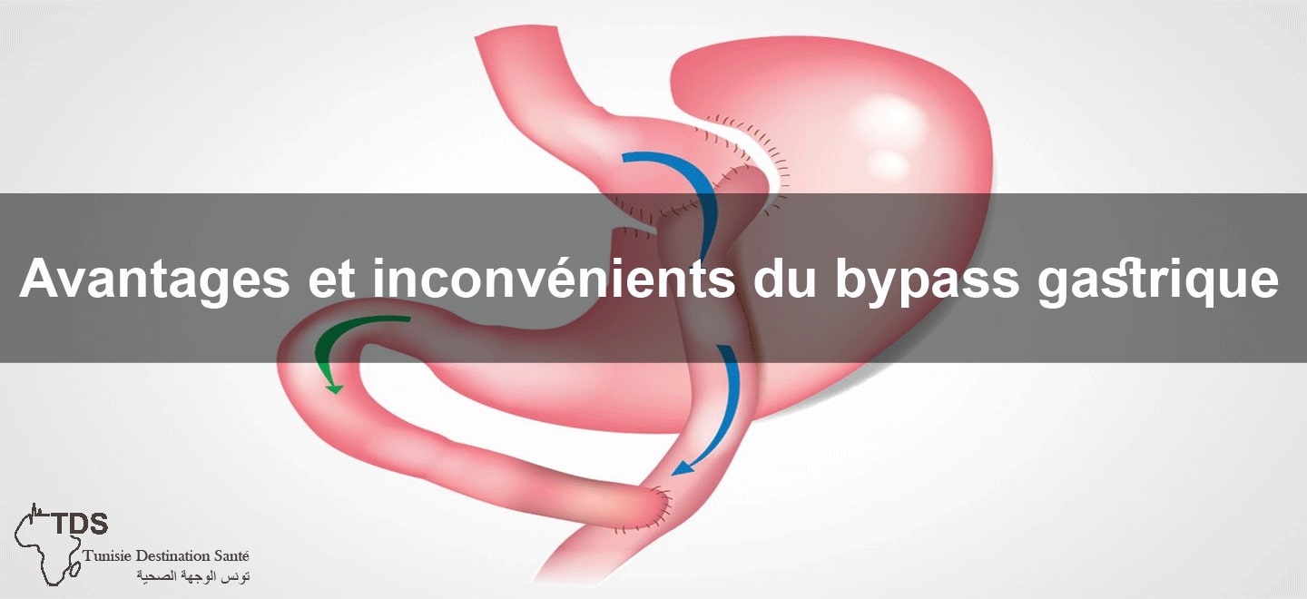 avantages inconvénient bypass