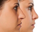 rhinoplastie tunisie