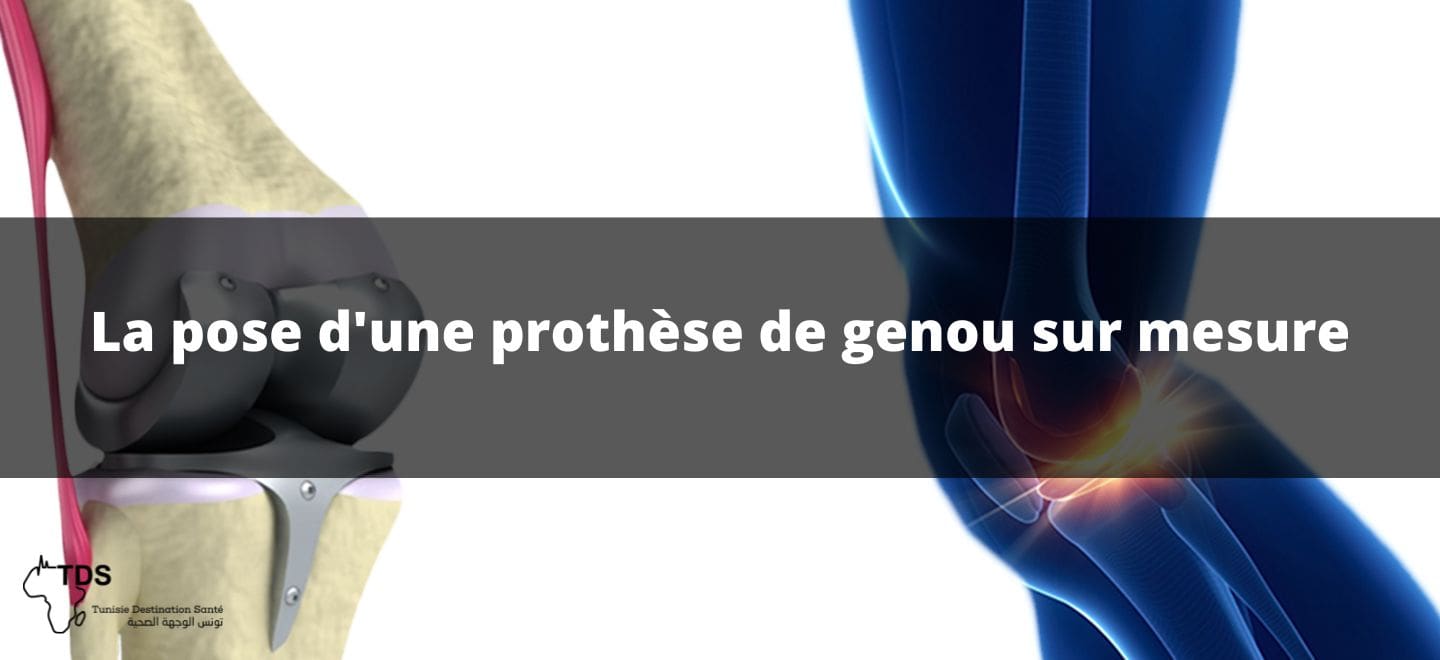 La pose d'une prothèse de genou sur mesure