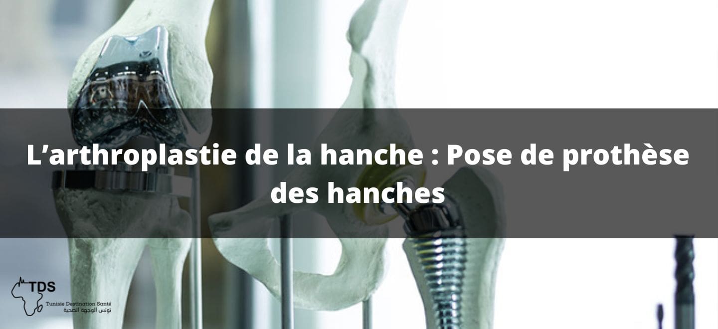 L’arthroplastie de la hanche , Pose de prothèse des hanches