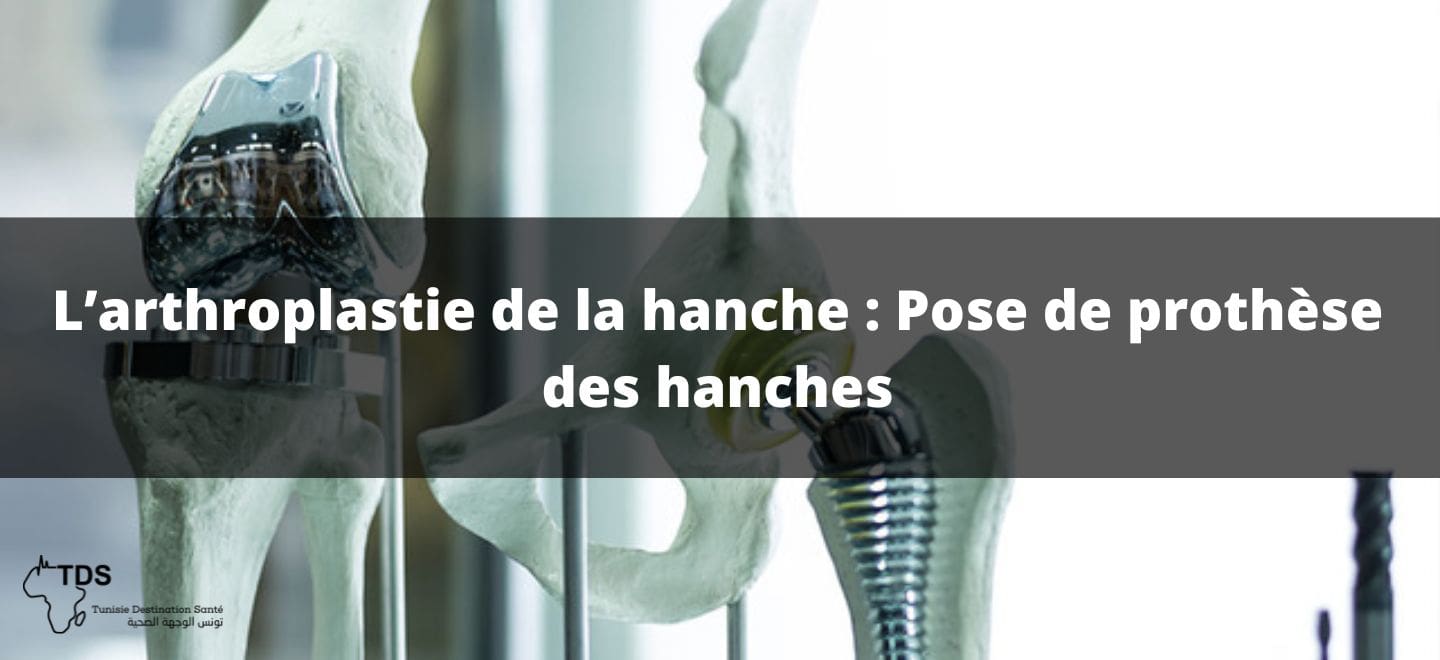 L’arthroplastie de la hanche , Pose de prothèse des hanches