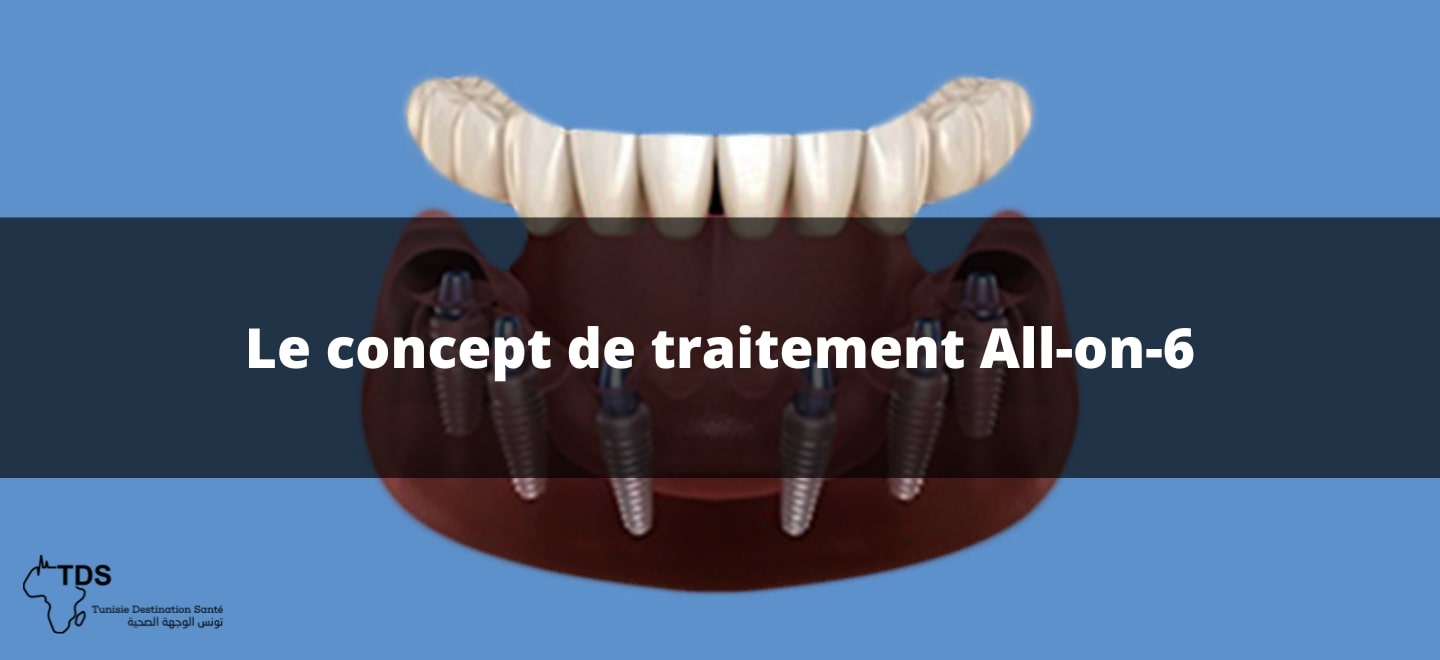 Le concept de traitement All on 6