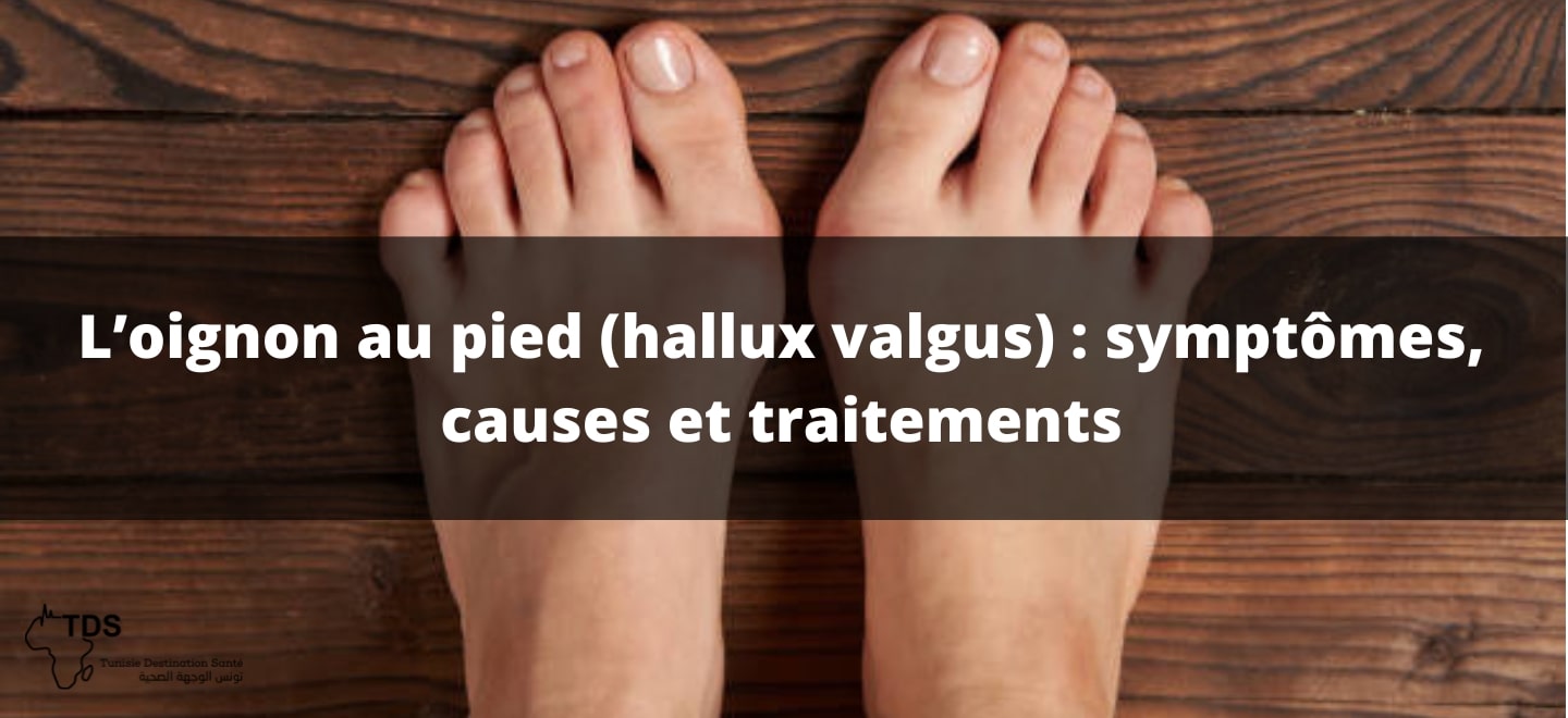 L’oignon au pied (hallux valgus) , symptômes , causes et traitements