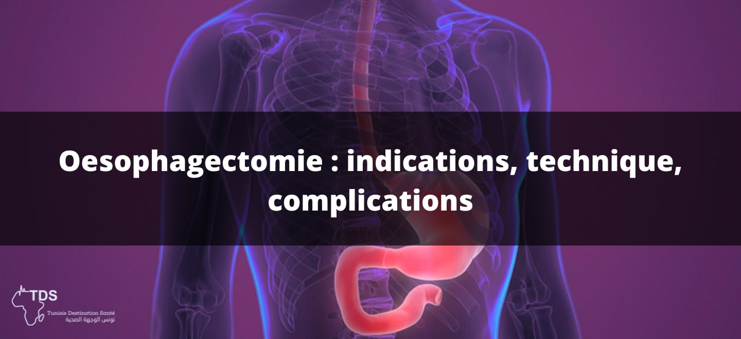 Oesophagectomie indications , technique , complications