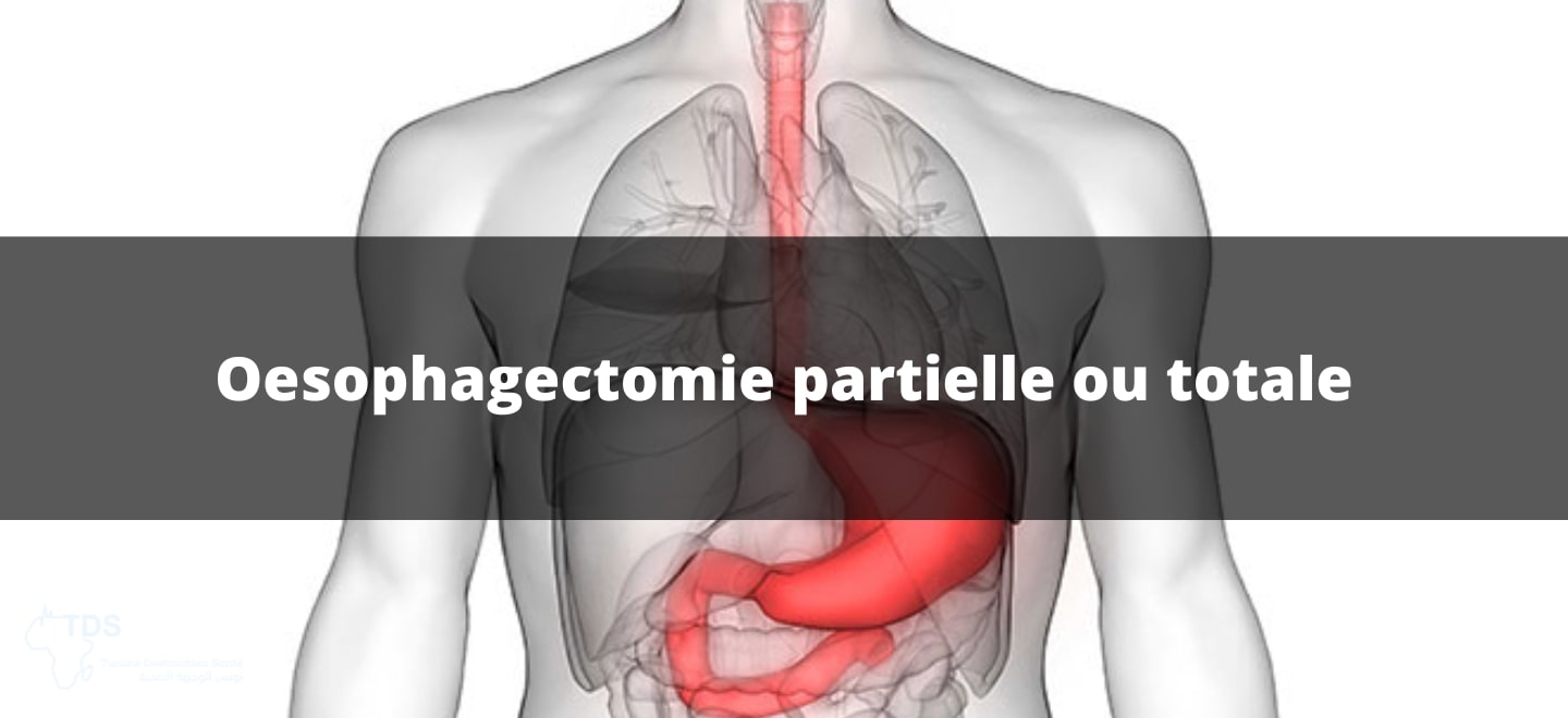 Oesophagectomie partielle ou totale