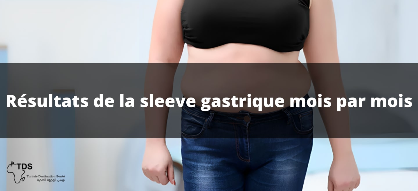 sleeve gastrique