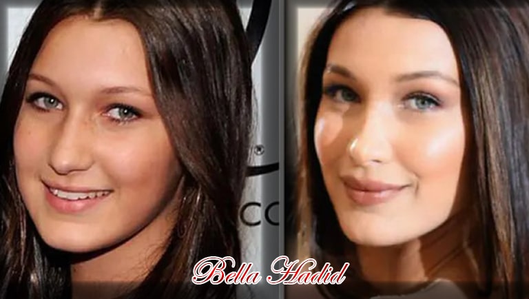 Bella Hadid l'avant et l'après chirurgie esthétique