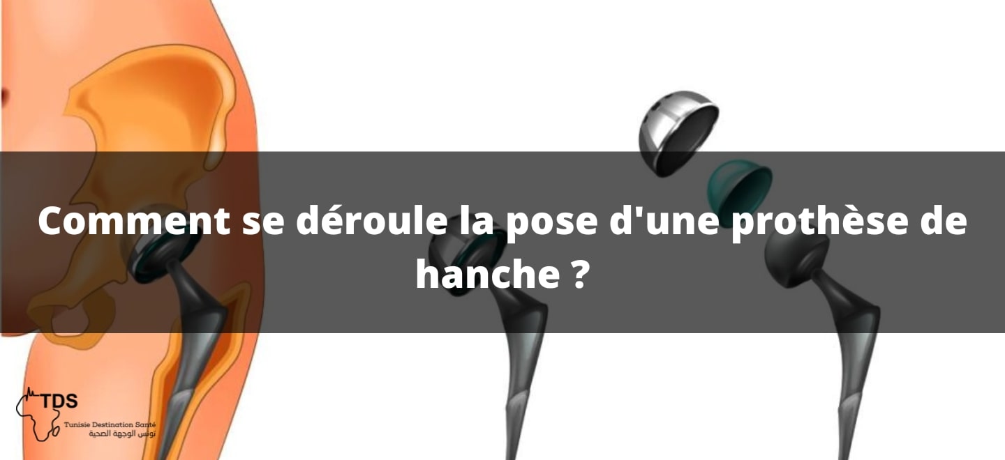 Comment se déroule la pose d'une prothèse de hanche