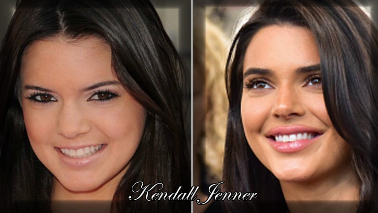 Kendall Jenner ,quelles opérations de chirurgie esthétique a-t-elle fait