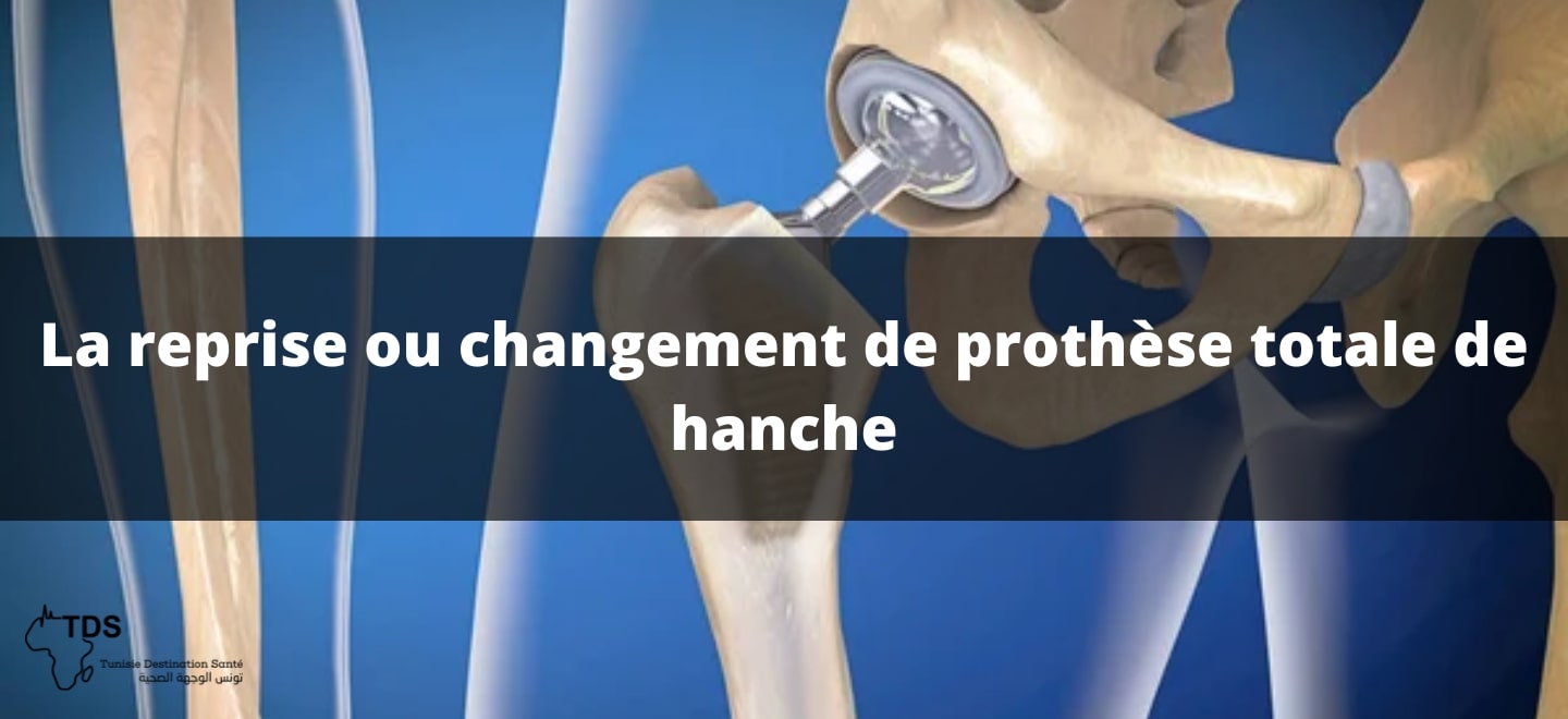 La-reprise ou hangement de prothèse totale de hanche