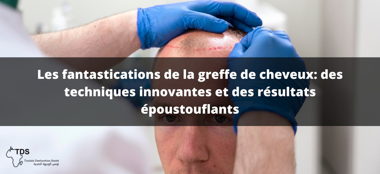 Les fantastications de la greffe de cheveux