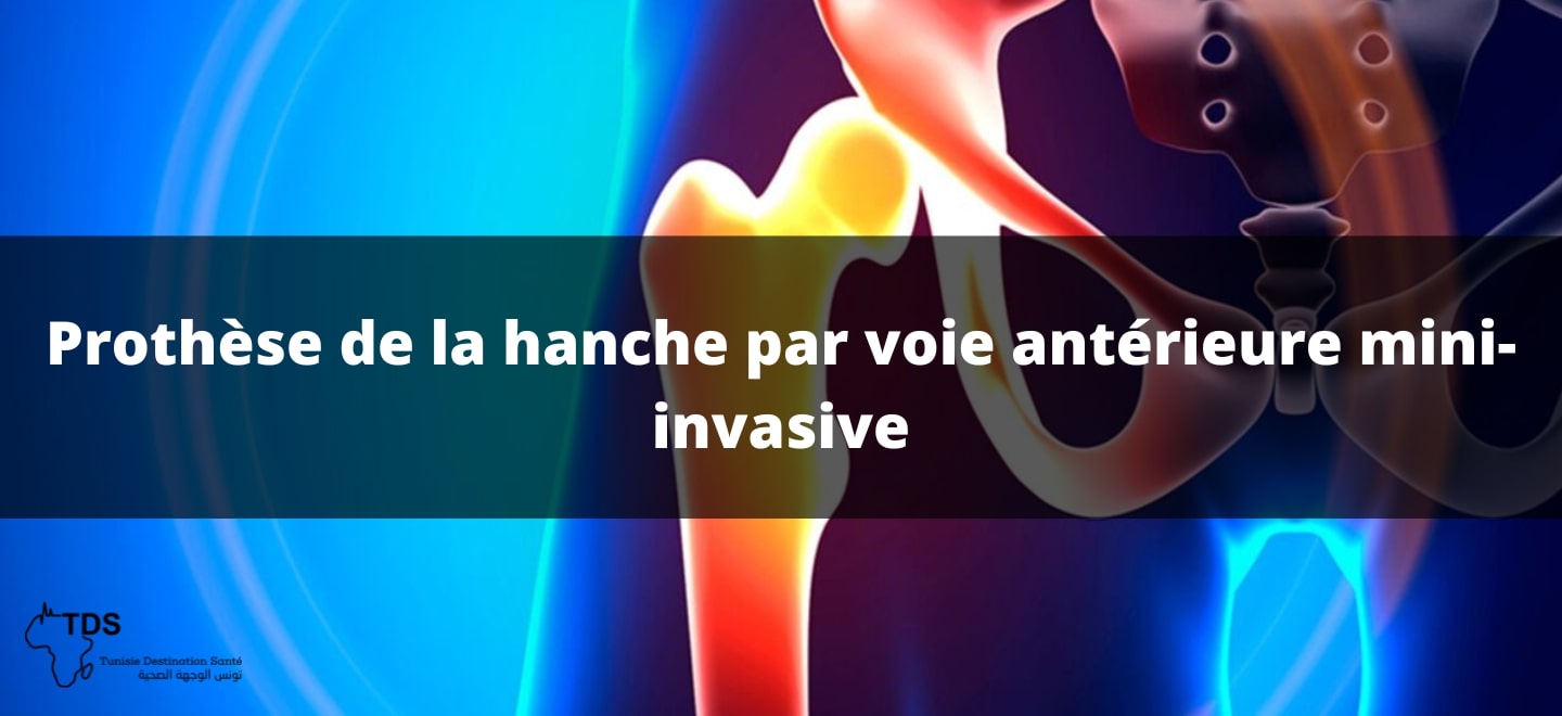 Prothèse de la hanche par voie antérieure mini-invasive