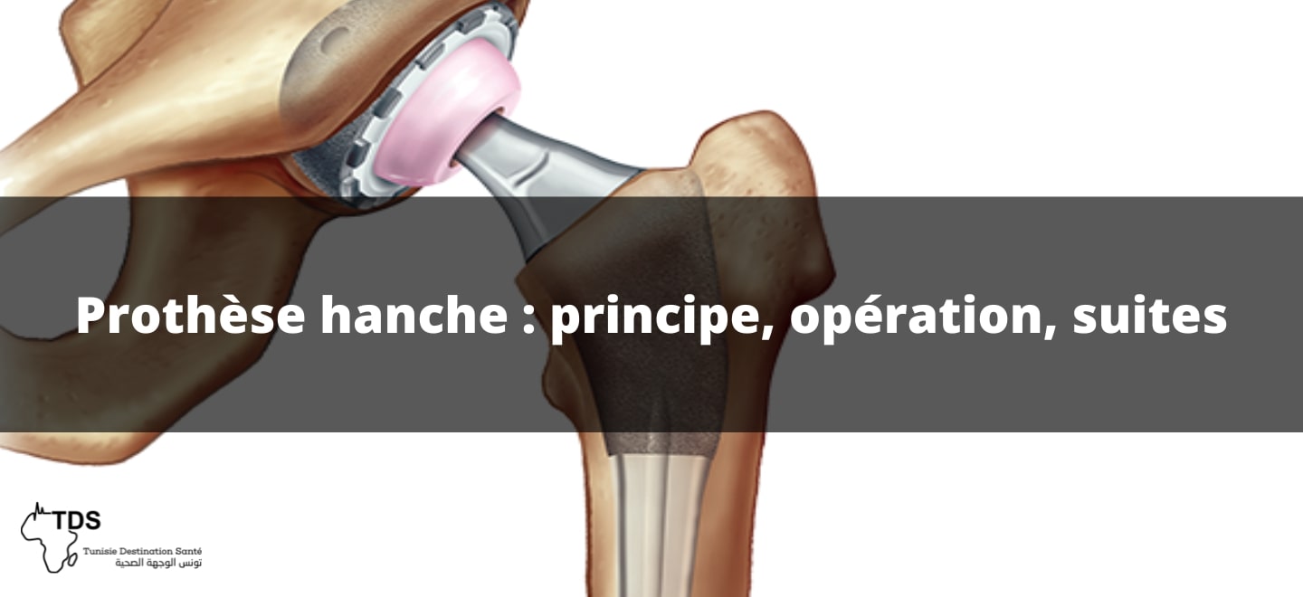 Prothèse hanche principe , opération , suites