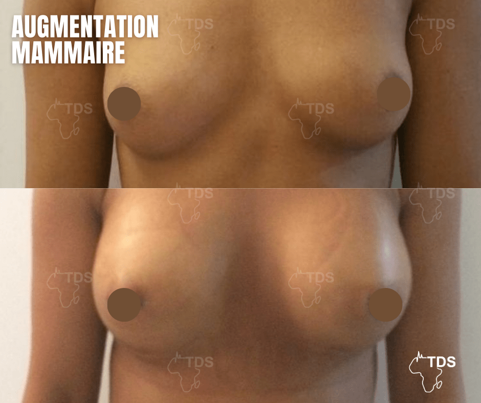 Augmentation mammaire avant apres 1