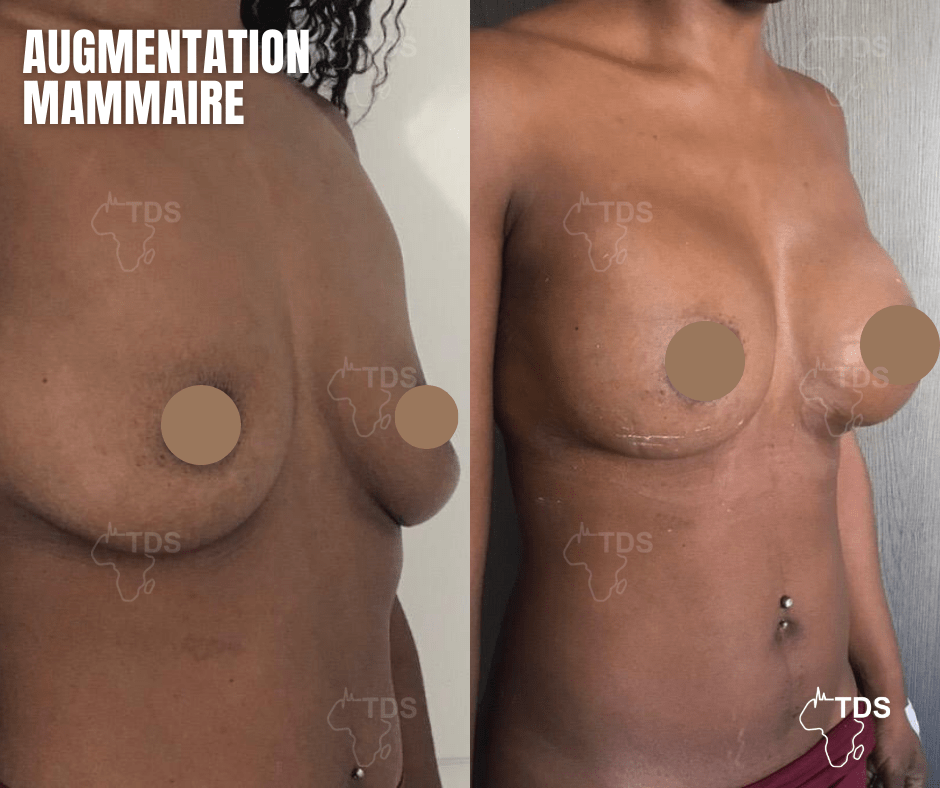 Augmentation mammaire avant apres 4