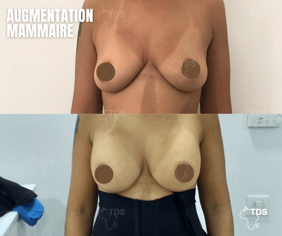 Augmentation mammaire avant apres 5