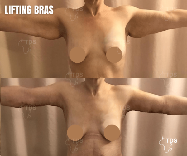 lifting bras avant après tds