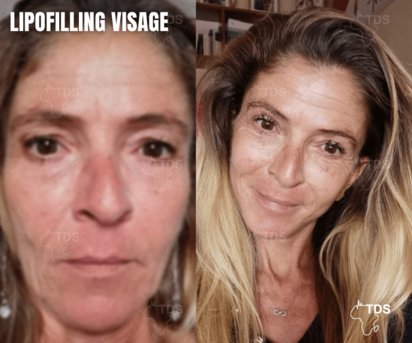 avant apres lipofilling visage