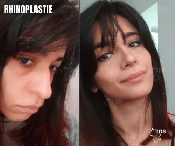 Rhinoplastie avant apres