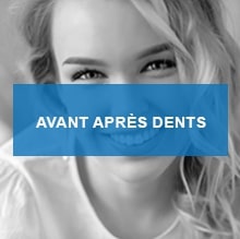 Avant apres dents