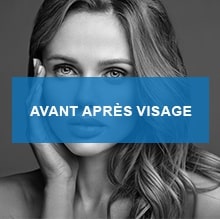 Avant apres visage