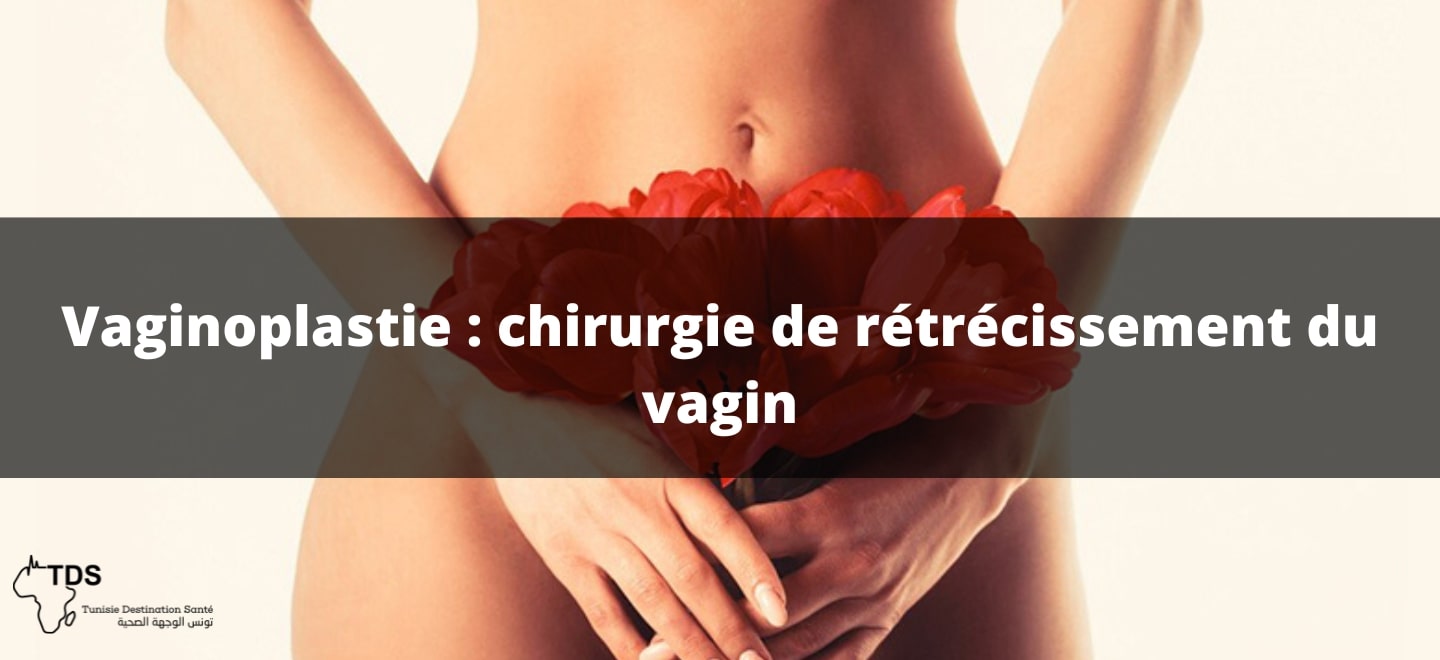 Vaginoplastie: Chirurgie de rétrécissement du vaginoplastie