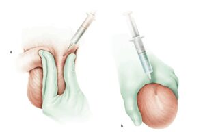 operation biopsie testiculaire